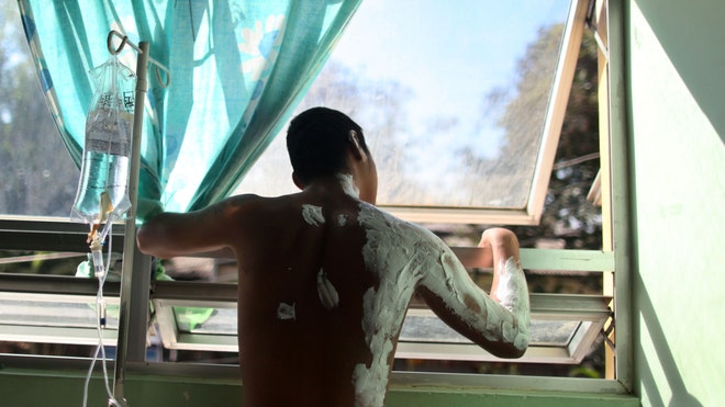 Honduras Burns.jpg